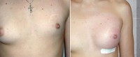 /album/galeria-de-fotos-antes-depois/aqualift-corporal-seios-assimetria-1-jpg/